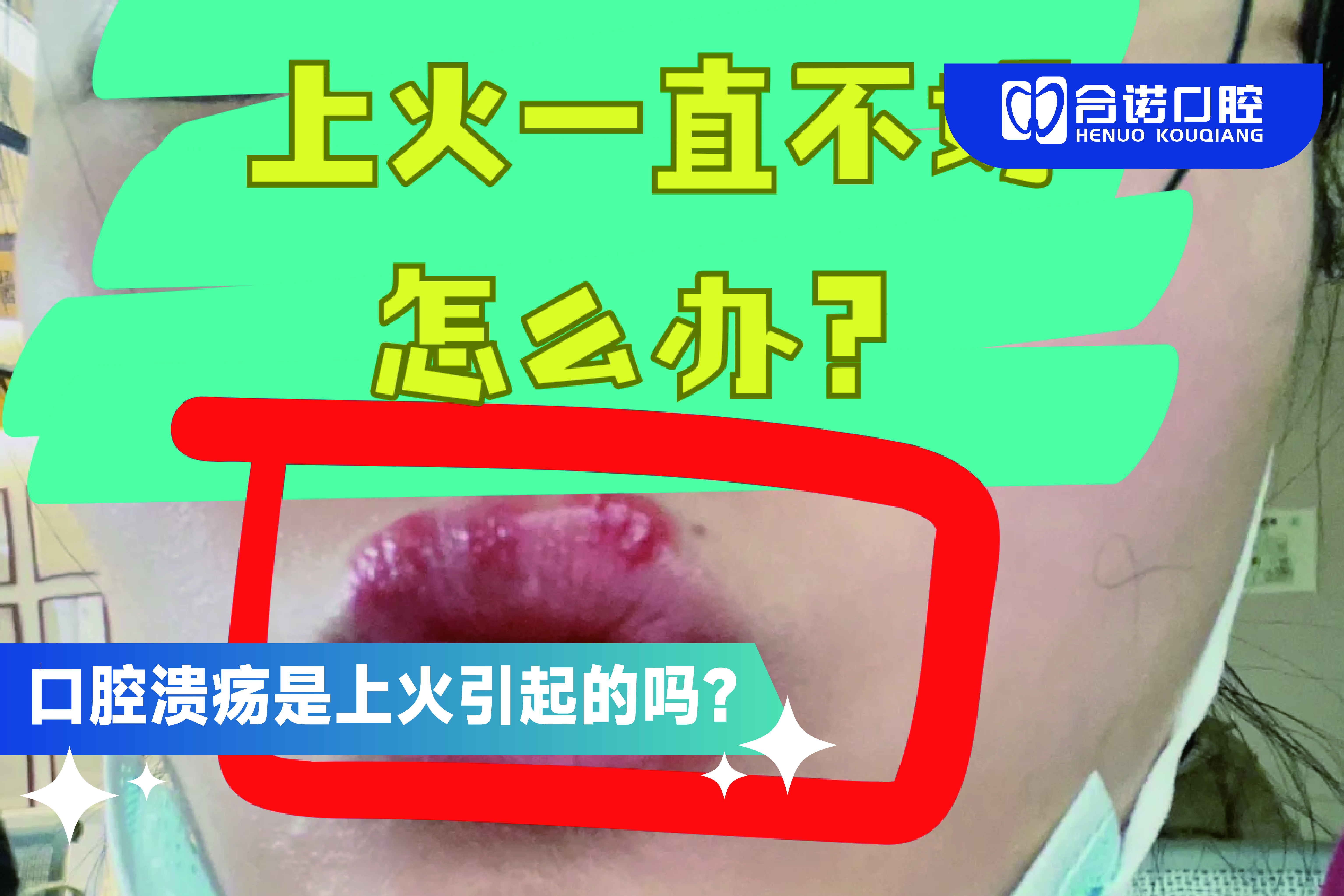 口腔潰瘍是否等同於「上火」？